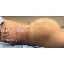 Fat Transfer Before & After Patient #663