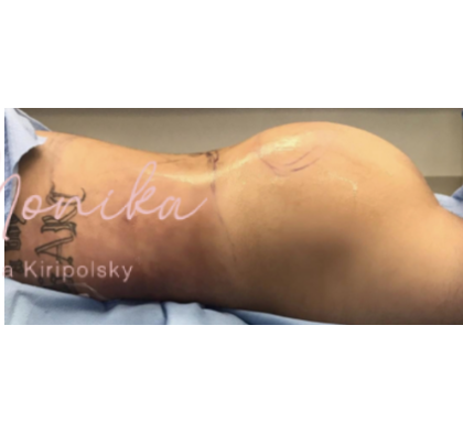 Fat Transfer Before & After Patient #663