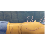 Liposuction / Liposculpture Before & After Patient #664
