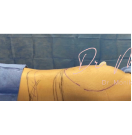 Liposuction / Liposculpture Before & After Patient #664