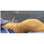 Liposuction / Liposculpture Before & After Patient #664