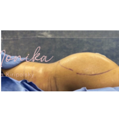 Liposuction / Liposculpture Before & After Patient #664