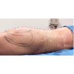 Liposuction / Liposculpture Before & After Patient #677