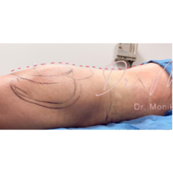 Liposuction / Liposculpture Before & After Patient #677