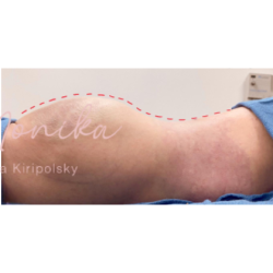 Liposuction / Liposculpture Before & After Patient #677