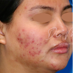 Acne Scarring Before & After Patient #775