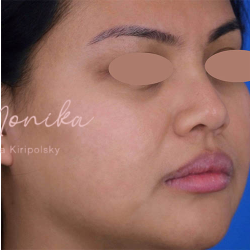 Acne Scarring Before & After Patient #775