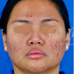 Acne Scarring Before & After Patient #775