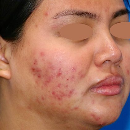 Acne Before & After Patient #775