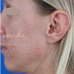 Acne Scarring Before & After Patient #779