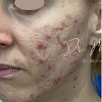 Acne Scarring Before & After Patient #779