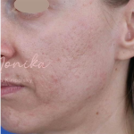 Acne Scarring Before & After Patient #779