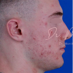 Acne Scarring Before & After Patient #776