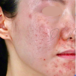 Acne Scarring Before & After Patient #777