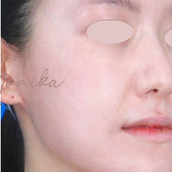 Acne Scarring Before & After Patient #777