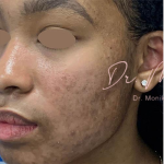 Acne Scarring Before & After Patient #778