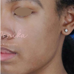 Acne Scarring Before & After Patient #778