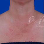 Diffuse Redness Before & After Patient #796