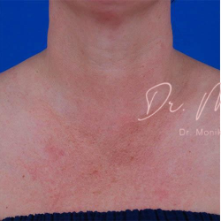 Diffuse Redness Before & After Patient #796