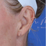 Earlobe Repair Before & After Patient #799