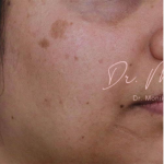 Hyperpigmentation Before & After Patient #809