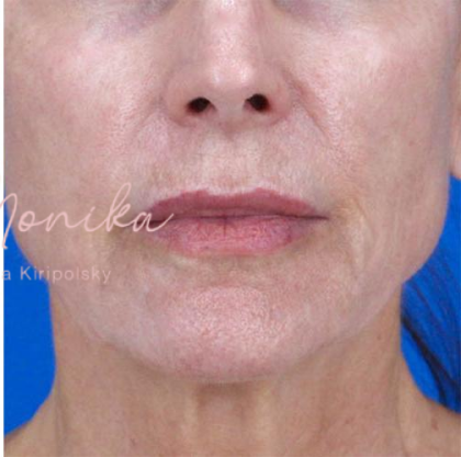 Skin Rejuvenation Before & After Patient #821