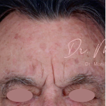 Chemical Peel Before & After Patient #1089