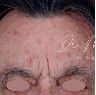 Chemical Peel Before & After Patient #1089