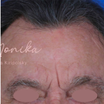 Chemical Peel Before & After Patient #1089