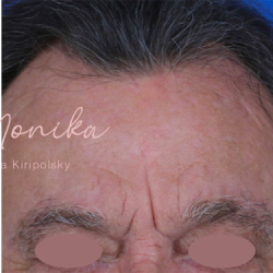 Chemical Peel Before & After Patient #1089