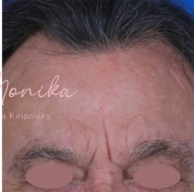 Chemical Peel Before & After Patient #1089