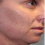 Submental Fat Removal Before & After Patient #1532