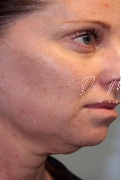 Submental Fat Removal Before & After Patient #1532