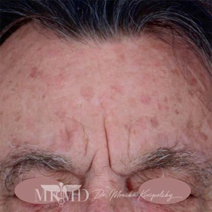Chemical Peel Before & After Patient #1089