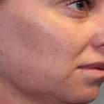 Kybella Before & After Patient #1532