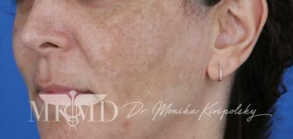 Melasma Before & After Patient #1535