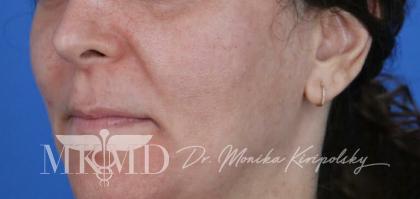 Melasma Before & After Patient #1535