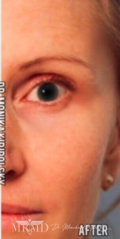 Xeomin Before & After Patient #604