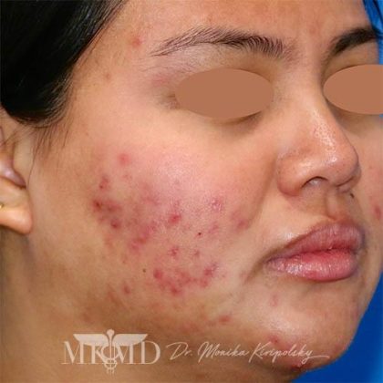 Acne Scarring Before & After Patient #775