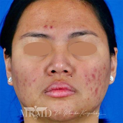Acne Scarring Before & After Patient #1531