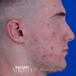 Acne Scarring Before & After Patient #776