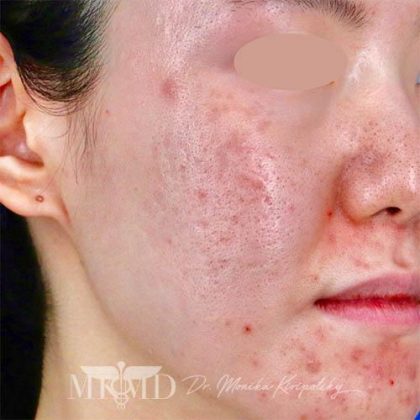 Acne Scarring Before & After Patient #777