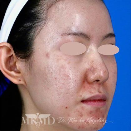 Acne Scarring Before & After Patient #1530