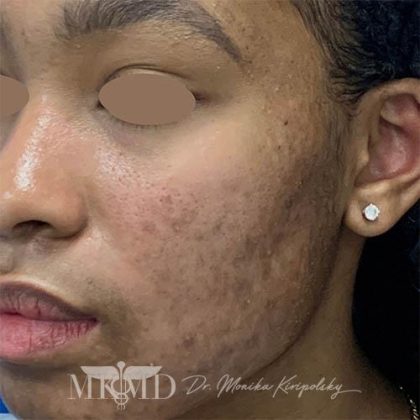 Acne Scarring Before & After Patient #778