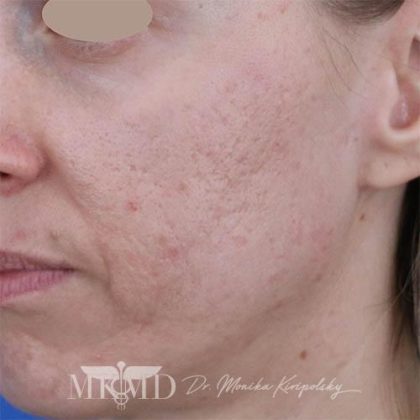 Acne Scarring Before & After Patient #1529