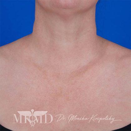 Diffuse Redness Before & After Patient #796