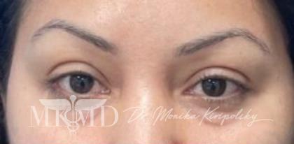 Xeomin Before & After Patient #603