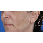 Melasma Before & After Patient #1535