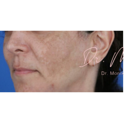 Melasma Before & After Patient #1535