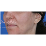 Melasma Before & After Patient #1535
